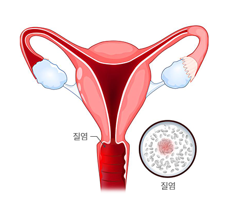 질 내부 분비물 물리적 제거