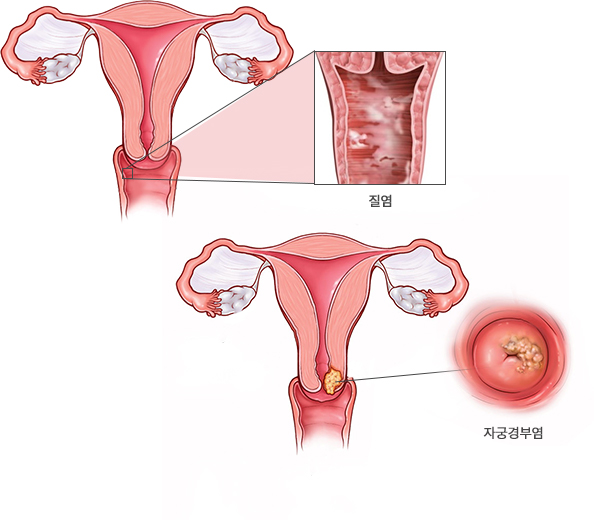 질염