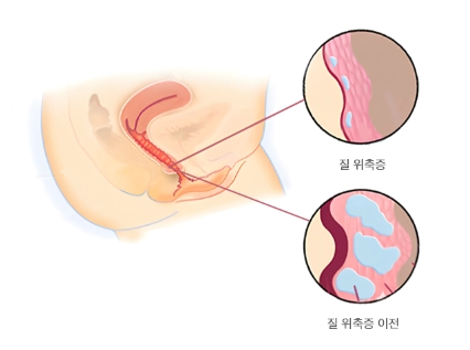 질 위축증
