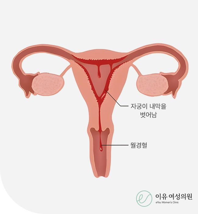 월경이상