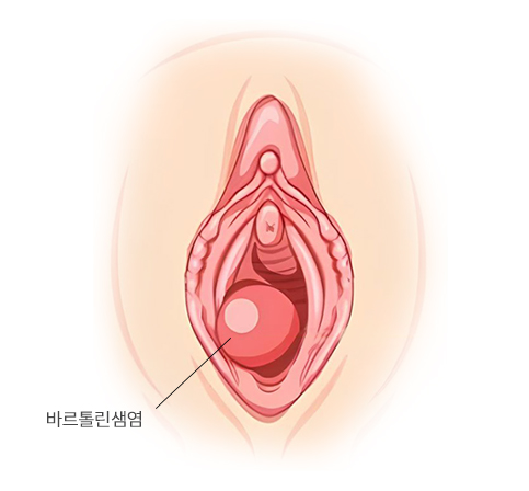 바르톨린선염