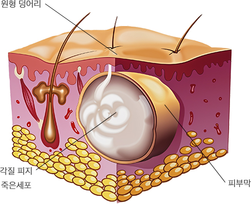 피지낭종