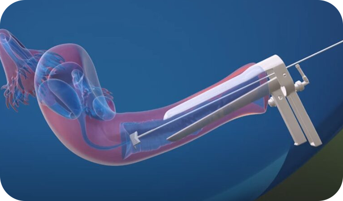일반 자궁경부세포검사(Pap smear)