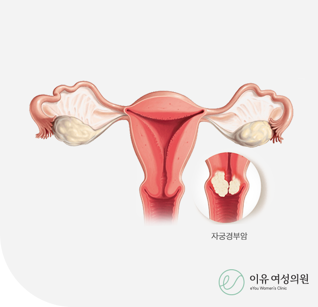 자궁경부암