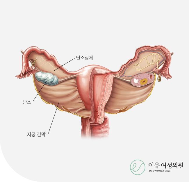 부인암 검진