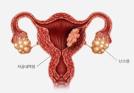 부인암의 종류