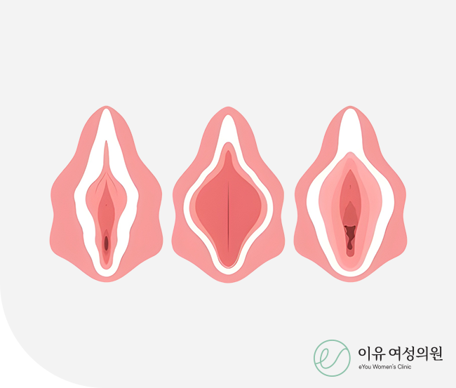 외음부 성형